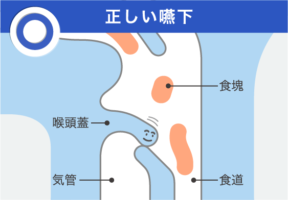 嚥下障害と誤嚥性肺炎 学ぶ ケア ニュートリー株式会社