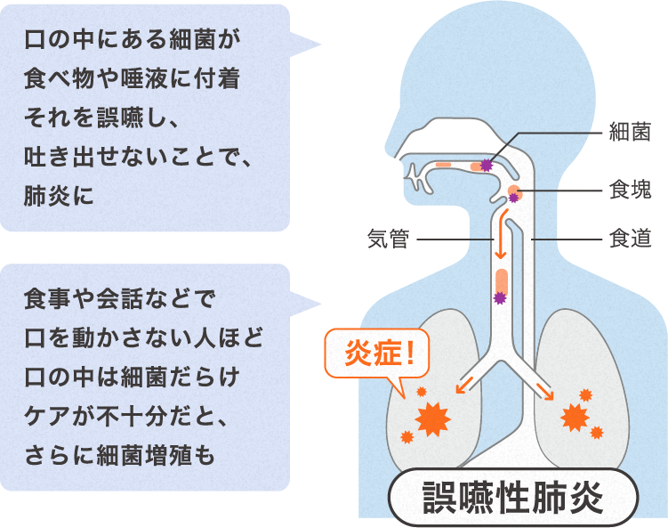 口の中にある細菌が食べ物や唾液に付着それを誤嚥し､吐き出せないことで､肺炎に / 食事や会話などで口を動かさない人ほど口の中は細菌だらけケアが不十分だと､さらに細菌増殖も