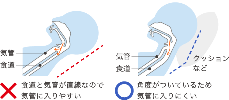 嚥下障害と誤嚥性肺炎 学ぶ ケア ニュートリー株式会社