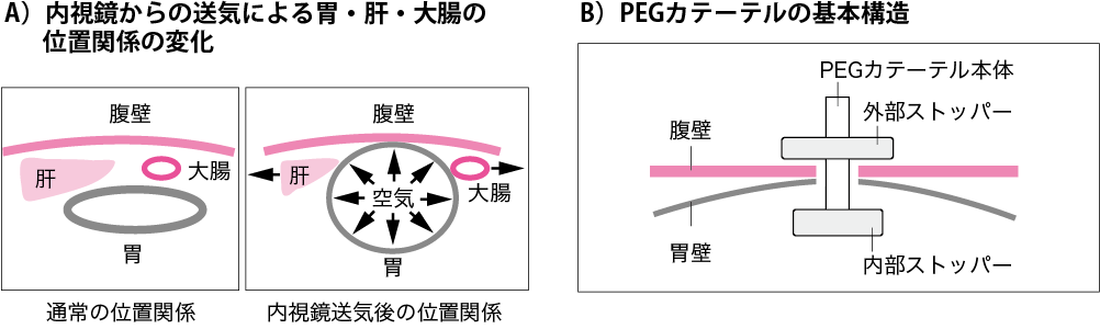 内視鏡的胃瘻造設術 手技から在宅管理まで