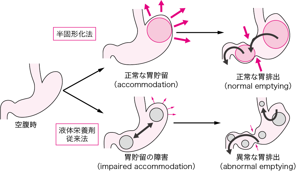 図Ⅰ● 半固形化法の機序