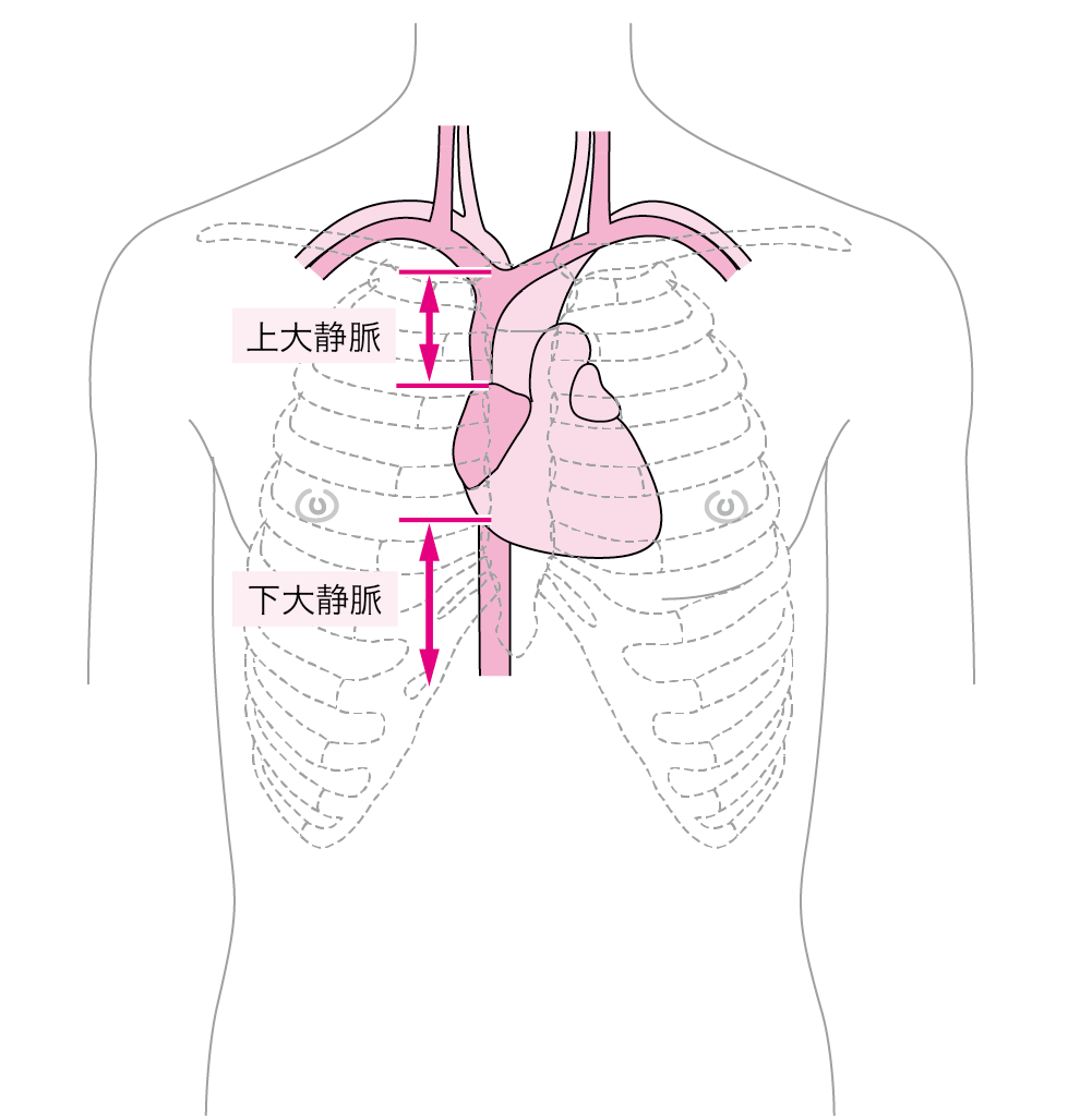 1 中心静脈カテーテル Cvc Central Venous Catheter ニュートリー株式会社