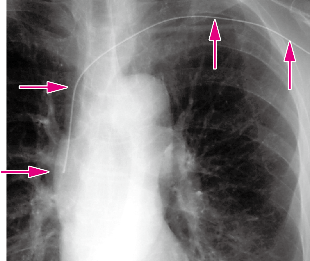 4 Picc Peripherally Inserted Central Catheter ニュートリー株式会社