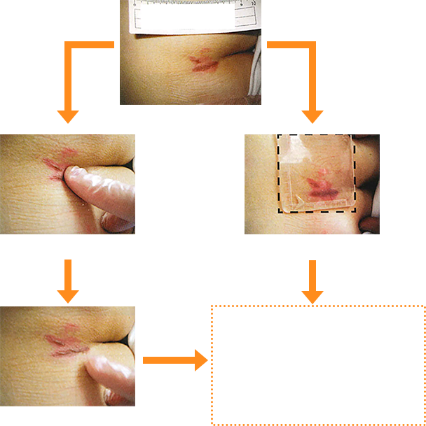 床ずれかどうか、チェックしてみましょうの図