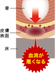 ⾻と⽪膚の間の⾎管が押しつぶされて⾎⾏不良となり、⽪膚や⽪下組織に栄養や酸素が⾏きわたらなくなることで発⽣します。